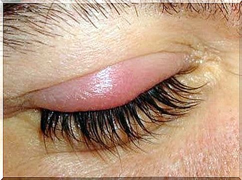 Stye on upper eyelid.