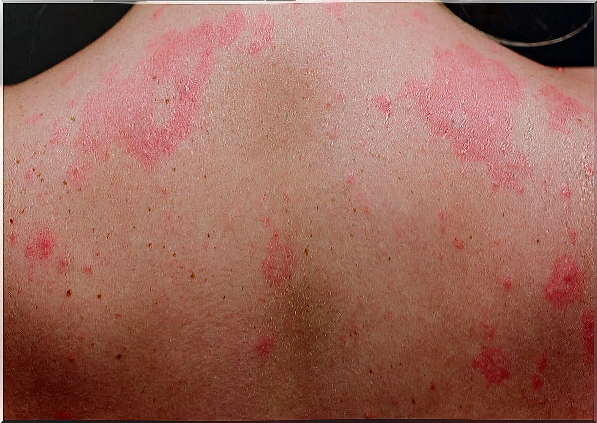 Urticaria due to allergy to dogs and cats.