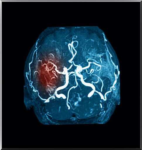 study of clots in the brain