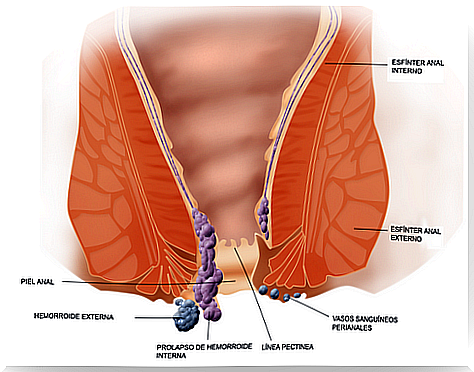 Hemorrhoids and piles.