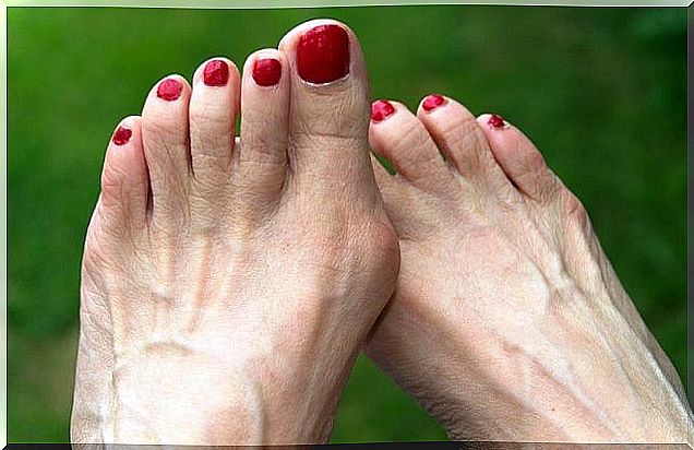 Bunions, one of the conditions caused by wearing heels