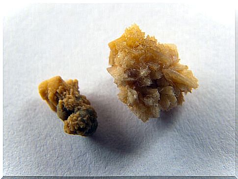 kidney stones