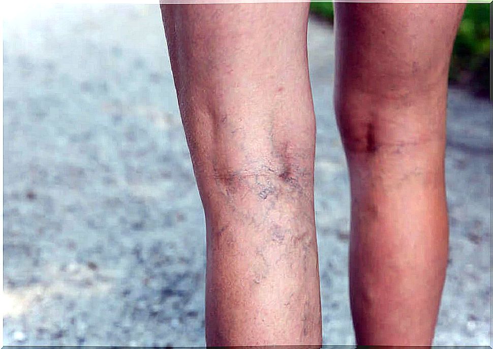 Varicose veins on the legs, a sign of poor blood circulation.