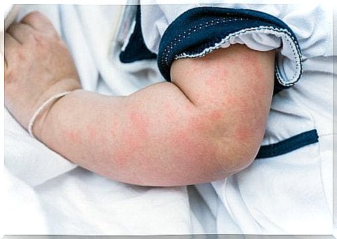 Rash in a baby