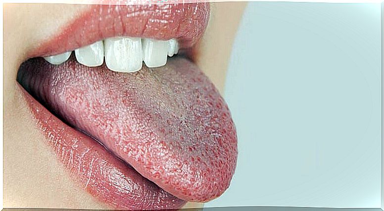 Burning mouth syndrome