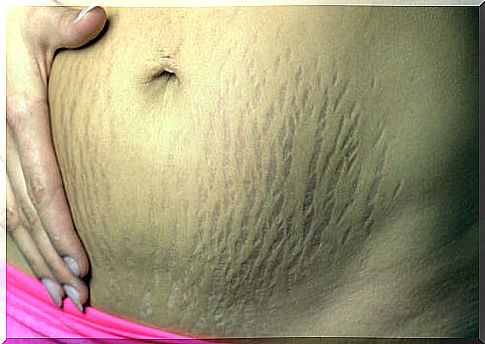 Stretch marks, how to improve your appearance naturally