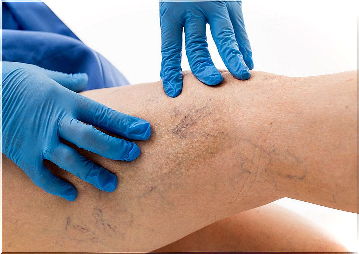 Varicose veins